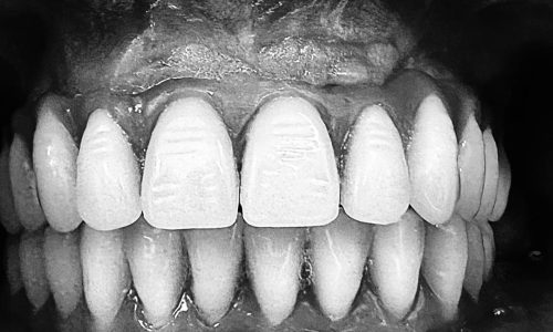 implantologia-dentale-dopo-2