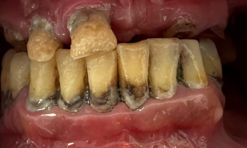 implantologia-dentale-prima-2